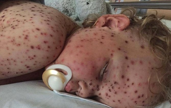 2-летний малыш попал в больницу с жуткими язвами. Диагноз врачей поставил всех в тупик!