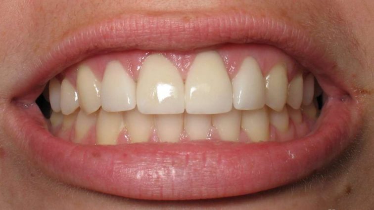 5 мифов об уходе за зубами